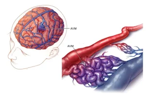 AVM'de ise; atardamarlar ve toplardamarlar, daha küçük kan damarları ve kılcal damarlardan oluşan bu destekleyici ağdan yoksun kalırlar.
