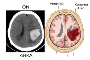Beyinde damar yumağı olması aşağıdaki riskli durumlara yol açabilir.