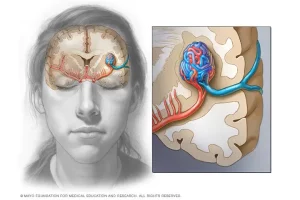 Beyin damar yumağı, AVM yırtılıp kanamaya neden olmadıkça herhangi bir belirti vermeyebilir.